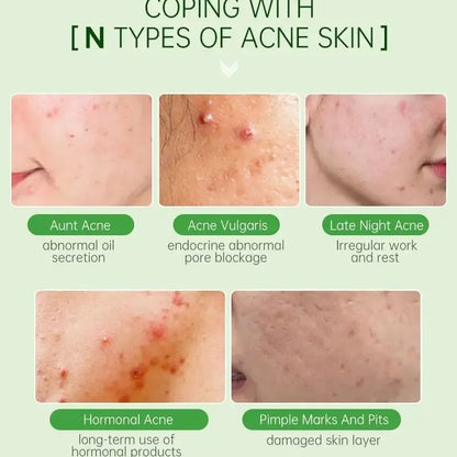 Tea Tree Facial Acne Removal Treatment