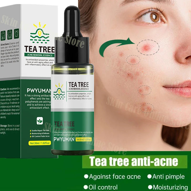 Tea Tree Facial Acne Removal Treatment